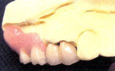 口の中を模型で見ると真中の2本も治療しました。見えるところは白い歯です。