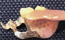 入れ歯の裏側、バネの変わりに段差がついていて被せ物の歯にしっかりと固定されます。