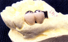 白い色が長持ちするセラミックと、少し軟らかいレジンと白い歯も2種類あります。